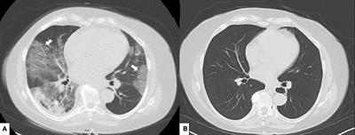 Neutralizing monoclonal antibodies against SARS-CoV-2 for COVID-19 pneumonia in a rituximab treated patient with systemic sclerosis—A case report and literature review